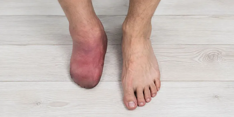 جلوگیری از قطع پای دیابتی